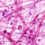 Esame del sangue per individuare precocemente cancro al pancreas: lo studio