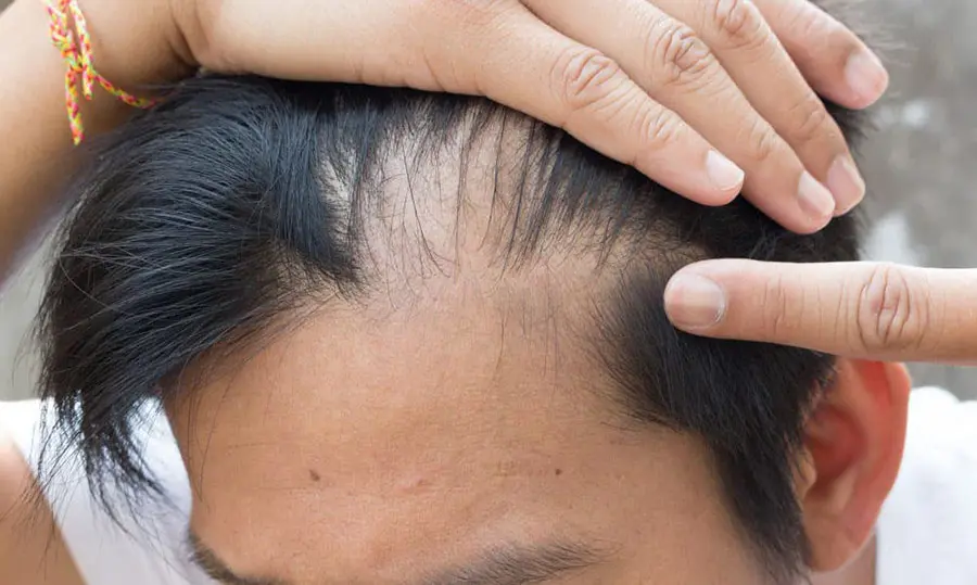 Crescita dei capelli: nuova speranza da stampanti 3D