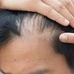 Crescita dei capelli: nuova speranza da stampanti 3D