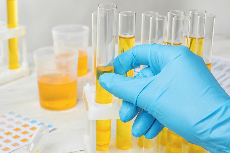 Test delle urine individua cancro alla prostata