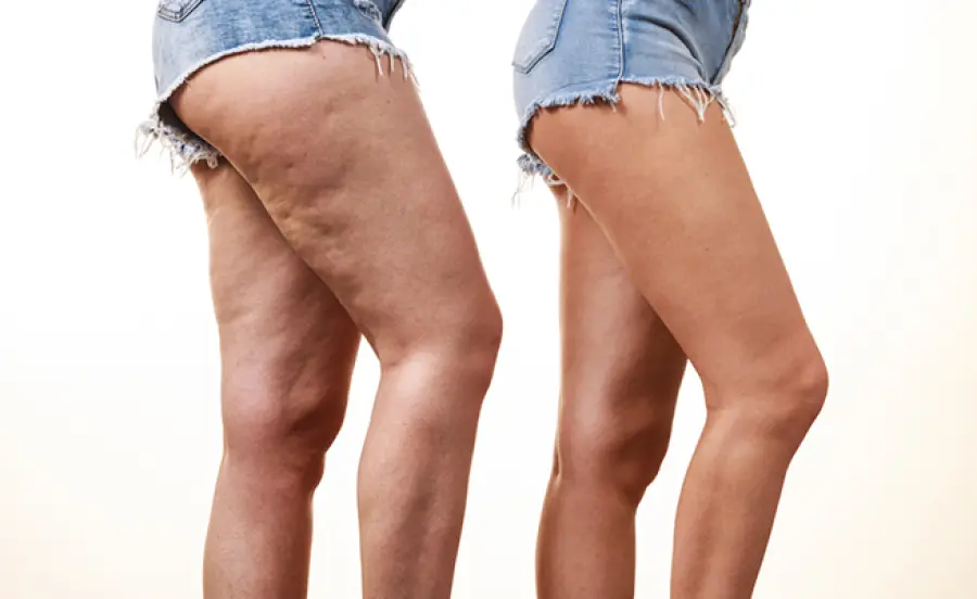 Avere le gambe grosse scongiura dal rischio ipertensione